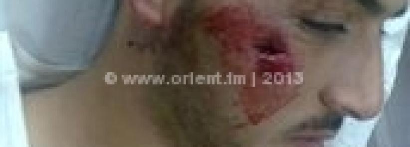 اصابة شاب برصاصة معدنية بوجهه في مواجهات بمخيم عايدة