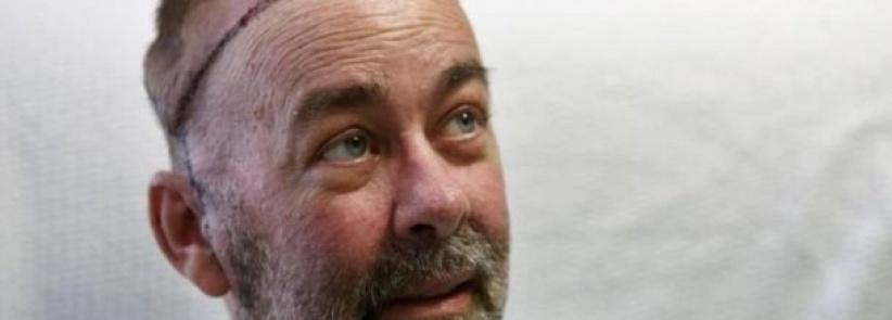 نجاح أول عملية لزراعة جمجمة وفروة رأس