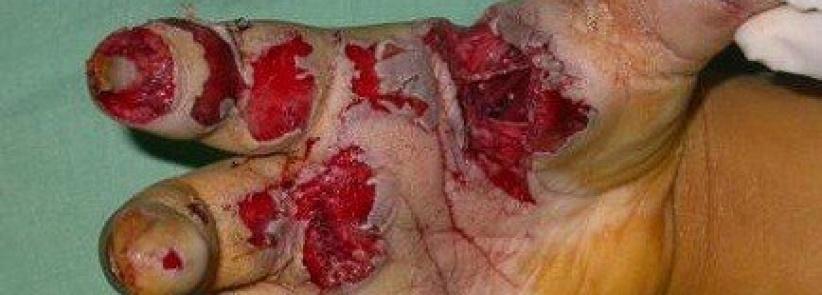 الصحة تدعو إلى عدم استخدام المفرقعات باحتفالات التوجيهي