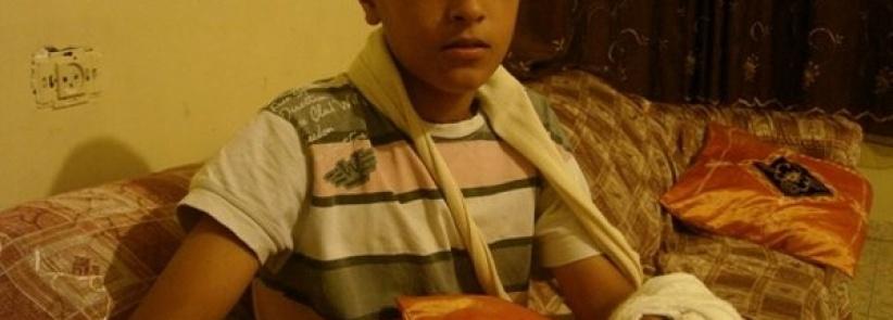 الجليل- بتر أصابع طفل كان يلهو بالمفرقعات