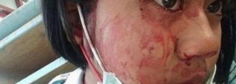 شابة تتعرق دماً... تعرّفوا على حالتها المرضية النادرة