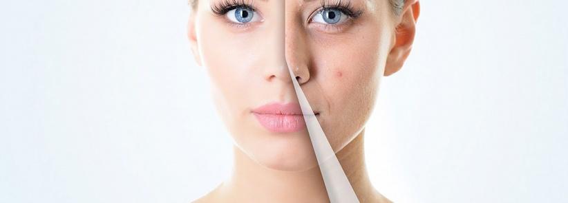 احذروا.. هذه الأطعمة تسبب “حب الشباب”