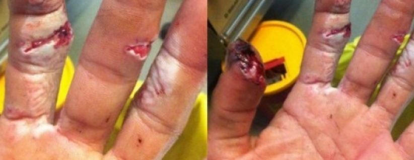 بسبب إضراب أطباء ‫‏مستشفى رفيديا‬ ضاع إصبعي