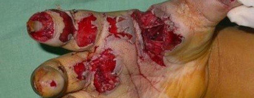 الصحة تدعو إلى عدم استخدام المفرقعات باحتفالات التوجيهي