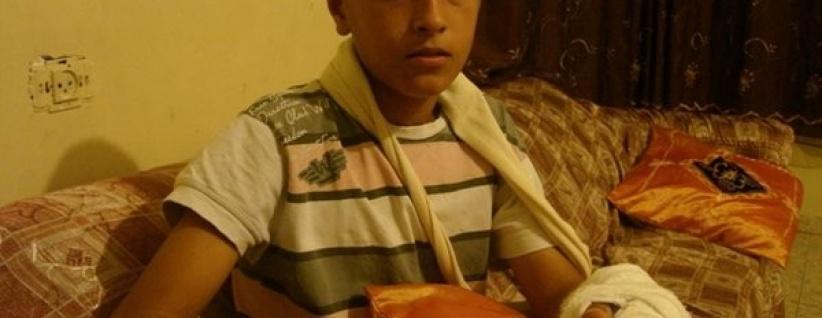 الجليل- بتر أصابع طفل كان يلهو بالمفرقعات