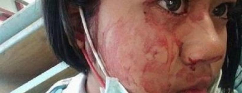 شابة تتعرق دماً... تعرّفوا على حالتها المرضية النادرة