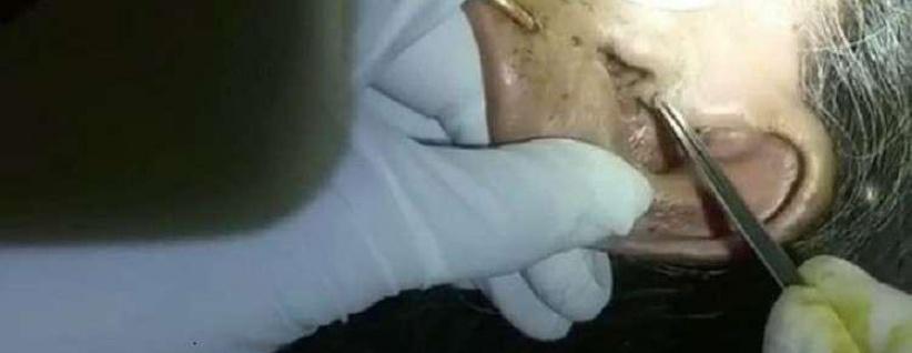 استخراج 30 يرقة حية من أذن مسنة!