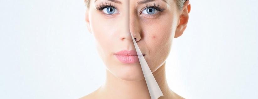 احذروا.. هذه الأطعمة تسبب “حب الشباب”