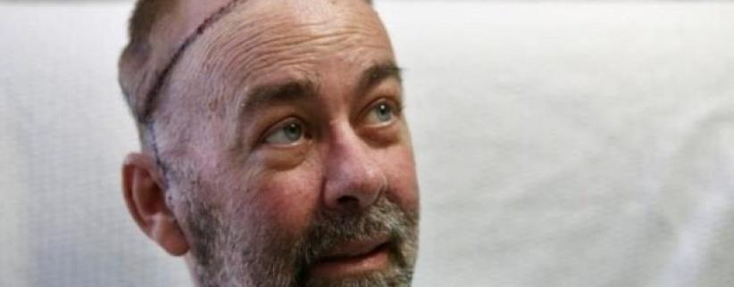 نجاح أول عملية لزراعة جمجمة وفروة رأس