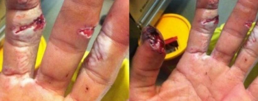 بسبب إضراب أطباء ‫‏مستشفى رفيديا‬ ضاع إصبعي