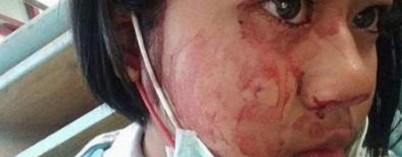 شابة تتعرق دماً... تعرّفوا على حالتها المرضية النادرة