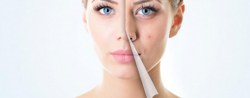 احذروا.. هذه الأطعمة تسبب “حب الشباب”