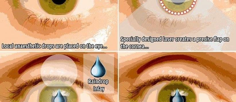 جهاز جديد في العين يغنيك عن نظارات القراءة