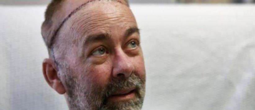 نجاح أول عملية لزراعة جمجمة وفروة رأس