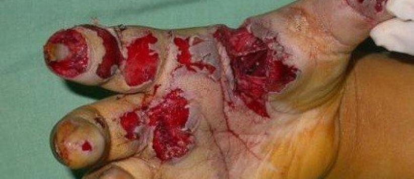 الصحة تدعو إلى عدم استخدام المفرقعات باحتفالات التوجيهي