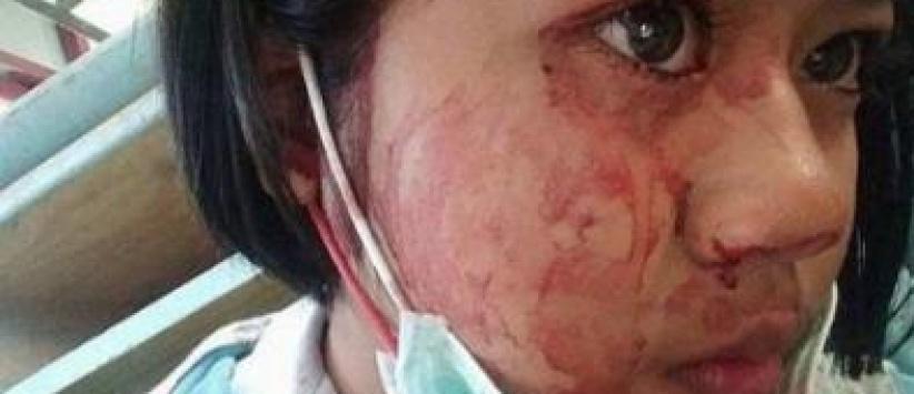 شابة تتعرق دماً... تعرّفوا على حالتها المرضية النادرة