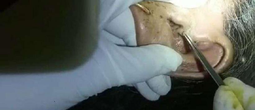 استخراج 30 يرقة حية من أذن مسنة!