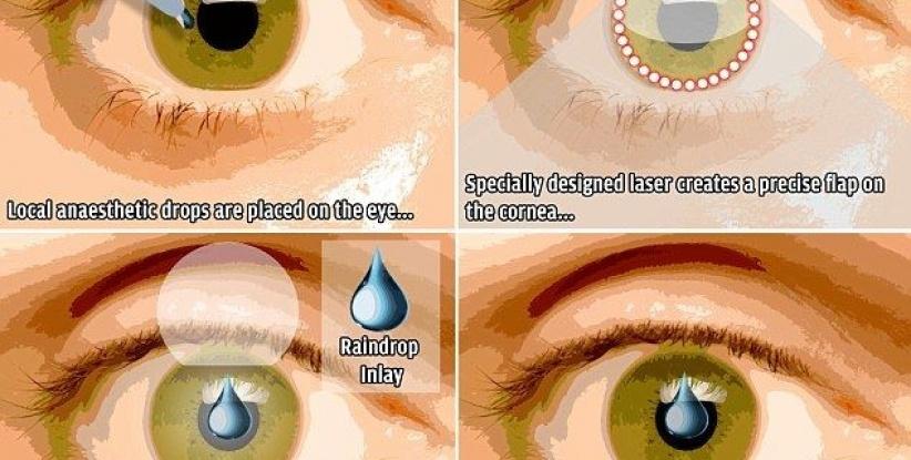 جهاز جديد في العين يغنيك عن نظارات القراءة