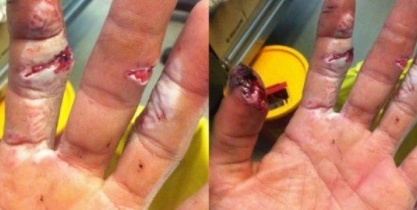 بسبب إضراب أطباء ‫‏مستشفى رفيديا‬ ضاع إصبعي