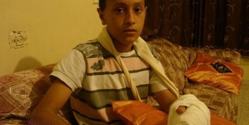 الجليل- بتر أصابع طفل كان يلهو بالمفرقعات