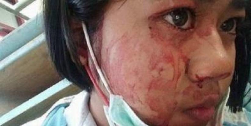 شابة تتعرق دماً... تعرّفوا على حالتها المرضية النادرة