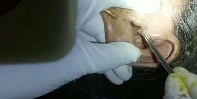 استخراج 30 يرقة حية من أذن مسنة!
