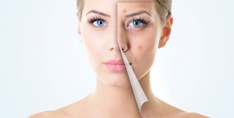 احذروا.. هذه الأطعمة تسبب “حب الشباب”