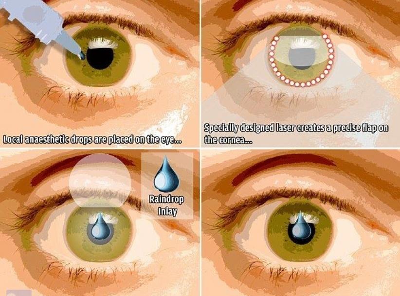 جهاز جديد في العين يغنيك عن نظارات القراءة