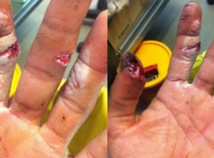 بسبب إضراب أطباء ‫‏مستشفى رفيديا‬ ضاع إصبعي