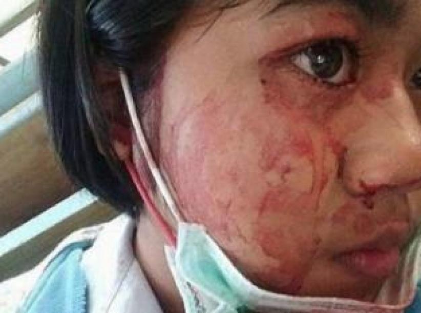 شابة تتعرق دماً... تعرّفوا على حالتها المرضية النادرة