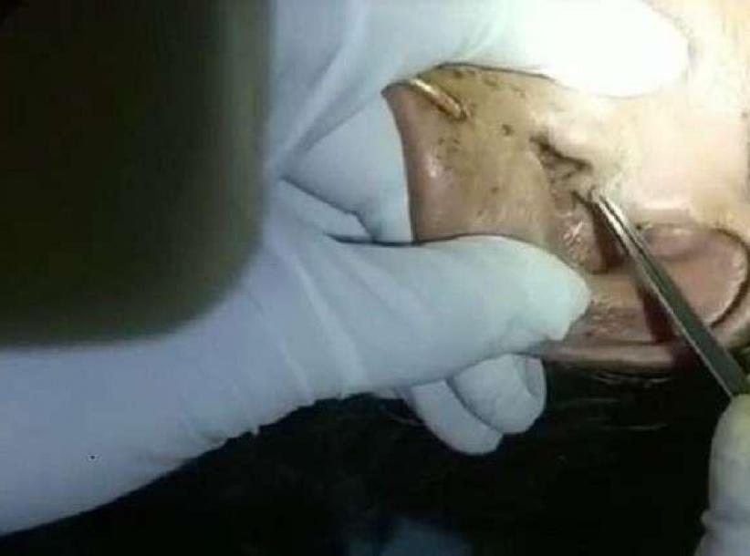 استخراج 30 يرقة حية من أذن مسنة!