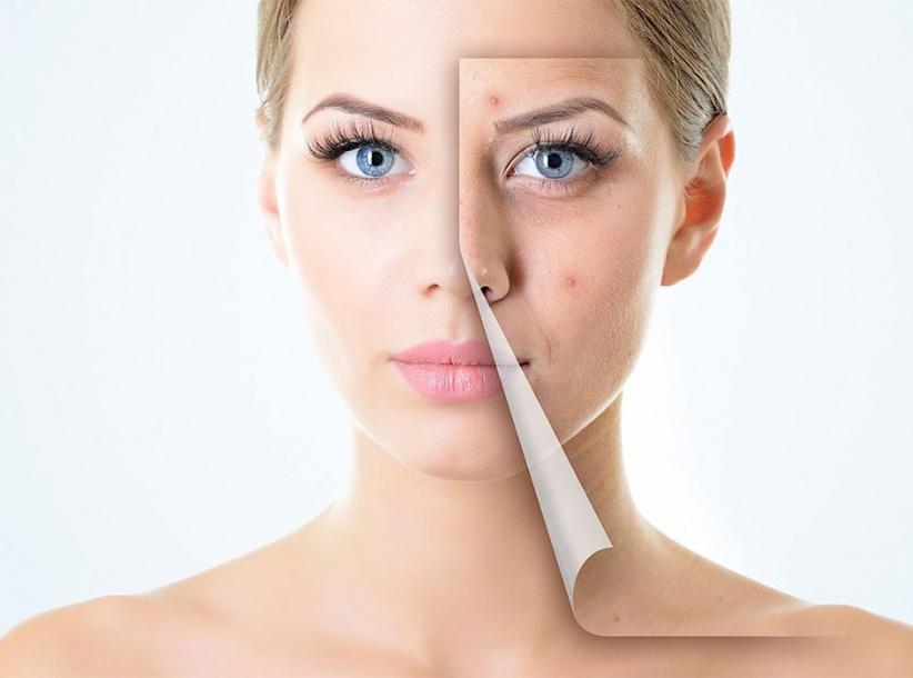 احذروا.. هذه الأطعمة تسبب “حب الشباب”