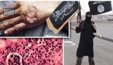 داعش يقتل أنصاره المصابة بالوباء ويحرق الجثة