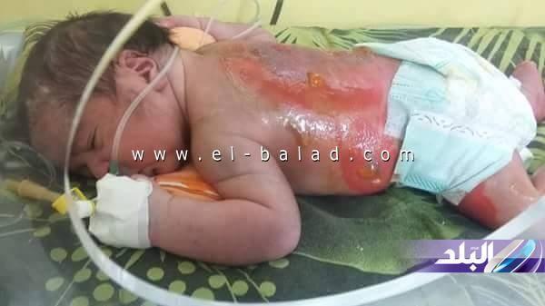 بالصور| احتراق طفل رضيع داخل حضانة بالإسكندرية