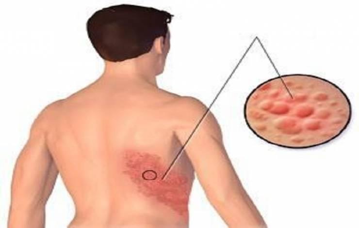 ما هو الحزام الناري وأعراضه وطرق علاجه