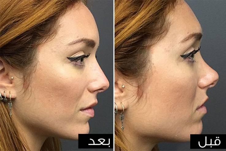 تجميل الأنف في 5 دقائق فقط ومن دون جراحة