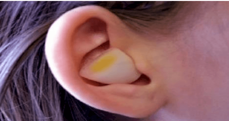 نتيجة مذهلة لوضع قطعة ثوم أو بصل داخل أذنك !