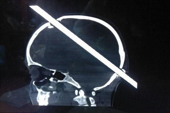 صور- لن تصدّق ما الذي اخترق جمجمة هذا الشاب