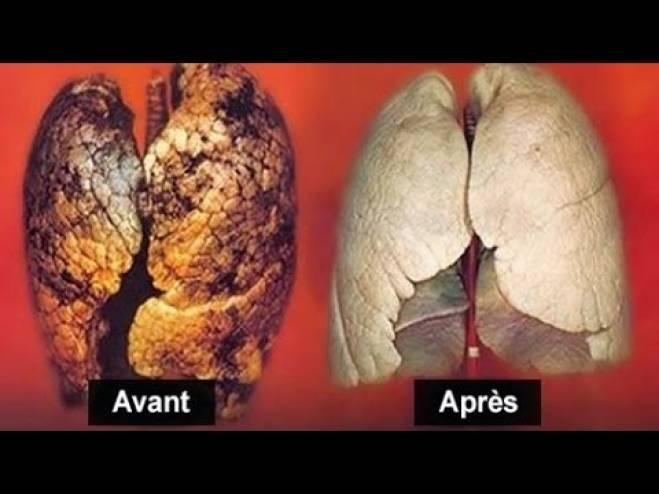 فيديو| للمدخنين.. أنجح طريقة لتنقية الرئتين في 72 ساعة فقط!