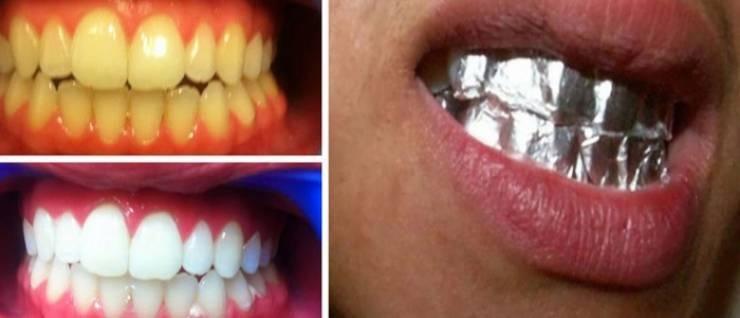 وصفة سحرية لتبييض أسنانك خلال ساعة بورق الألمنيوم