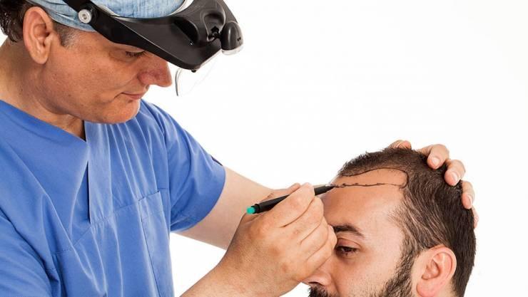 قبل الخضوع لعملية زراعة الشعر 7 امور يجب أن تعرفها !