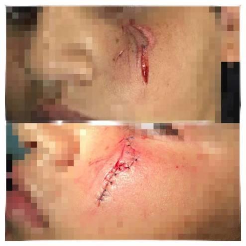 معلم يتسبب بجرح وهتك بوجنة طالب بمقدار 12 غرزة!