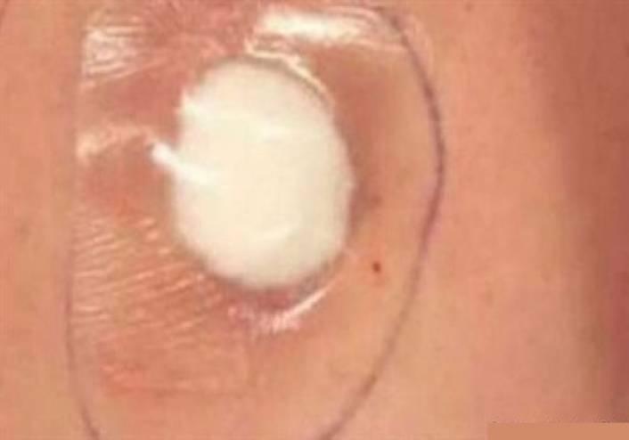 لن تتوقعوا ماذا يحصل في الجسم بعد إغلاق سرة البطن بالقطن!
