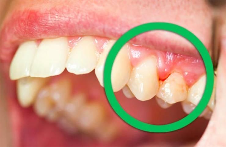7 علاجات طبيعية لالتهاب اللثة