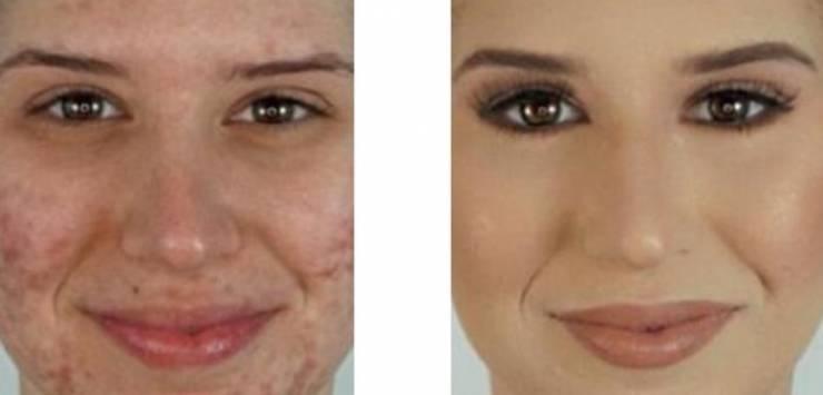 هذه أسهل طريقة للتخلص من حب الشباب في 10 دقائق