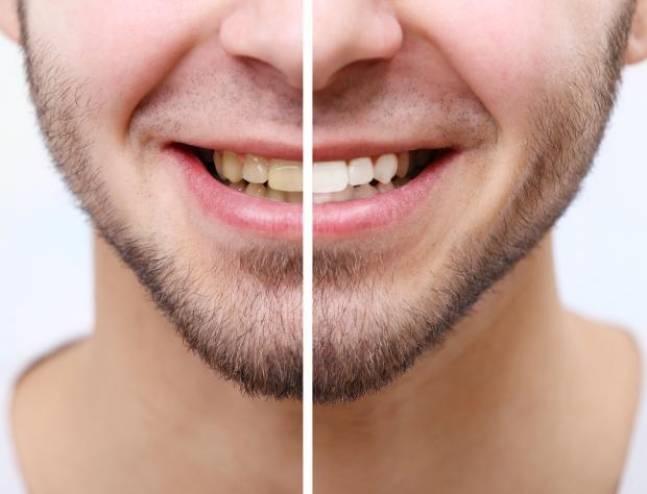 هام جدا ...7 أطعمة تزيد من اصفرار الاسنان!