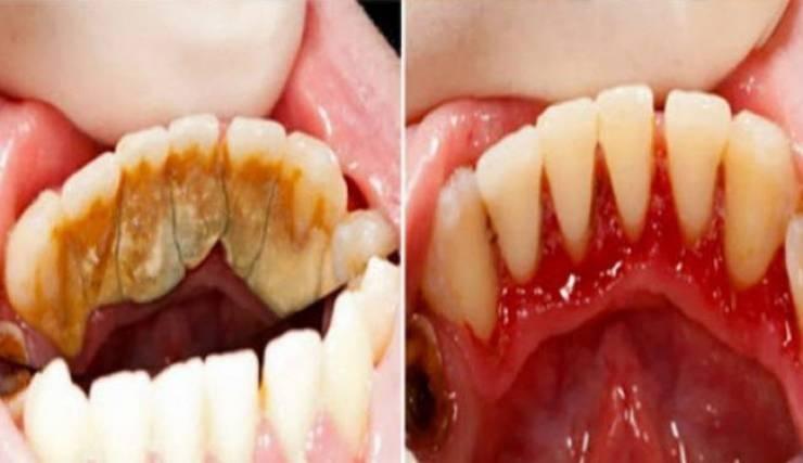 تخلص من رواسب الأسنان بسرعة