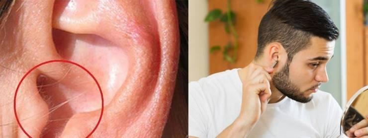 ما علاقة شعر الأذنين بالتجلطات القلبية؟