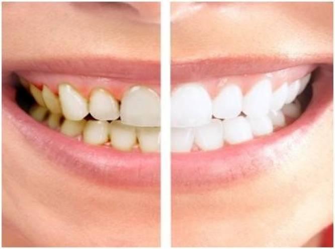 فيديو| هذا ما يحدث عندما لا تنظف أسنانك