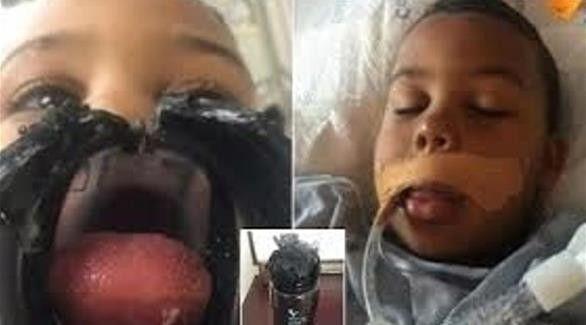 طفل يعلق لسانه بقارورة مياه.. فيمضي 4 أيام بالعناية المركزة